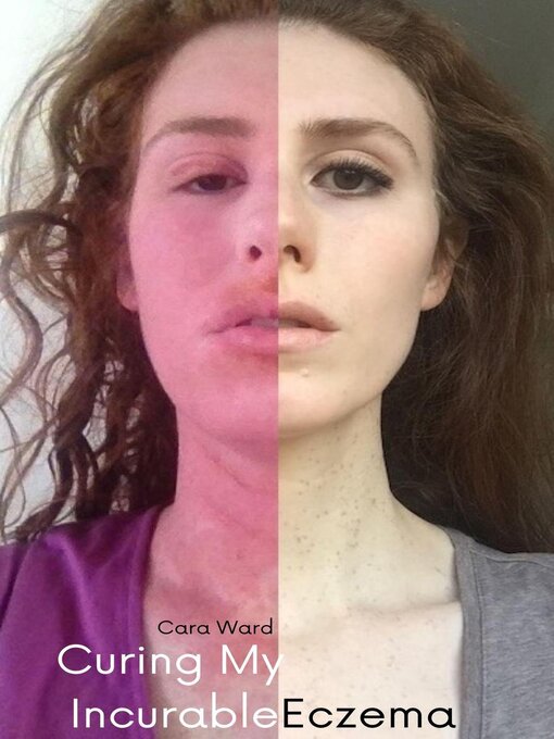 Cover image for Curing My Incurable Eczema